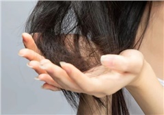 刘红艳 | 脱发原因有多种，对症下药就能让你发量翻倍再翻倍